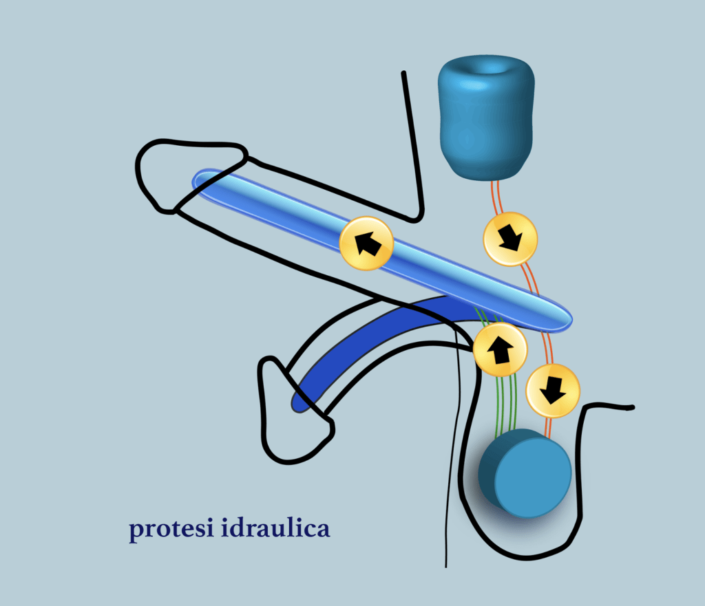 protesi idraulica