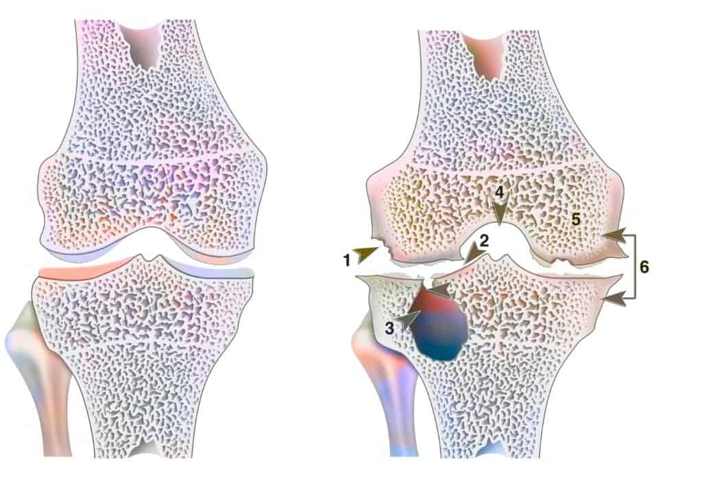 cartilagine ginocchio